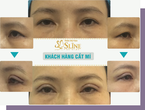 cham soc sau khi cat mi 5